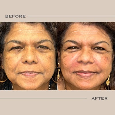 Dermal Fillers Before & After Gallery - Patient 891105 - Image 1