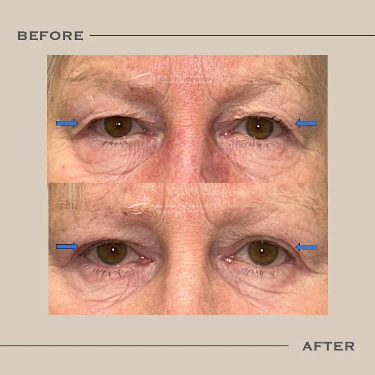 Upper Blepharoplasty Before & After Gallery - Patient 162649 - Image 1