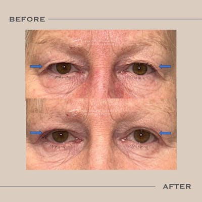 Upper Blepharoplasty Before & After Gallery - Patient 162649 - Image 1