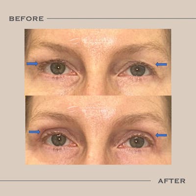 Upper Blepharoplasty Before & After Gallery - Patient 412579 - Image 1