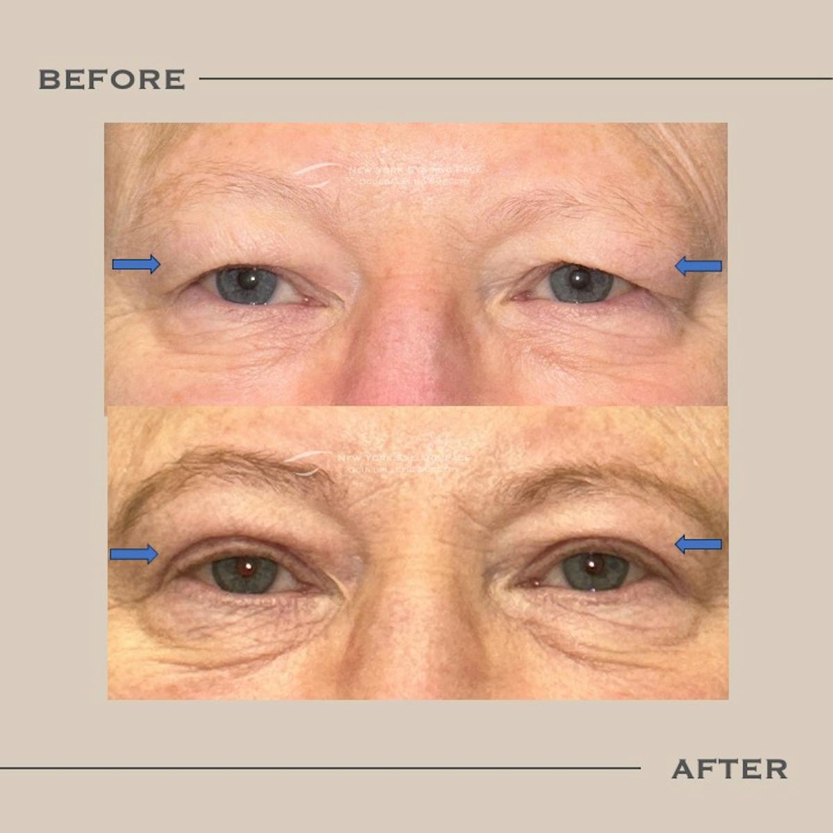 Upper Blepharoplasty Before & After Gallery - Patient 211740 - Image 1