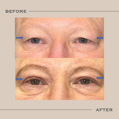 Upper Blepharoplasty Before & After Gallery - Patient 211740 - Image 1