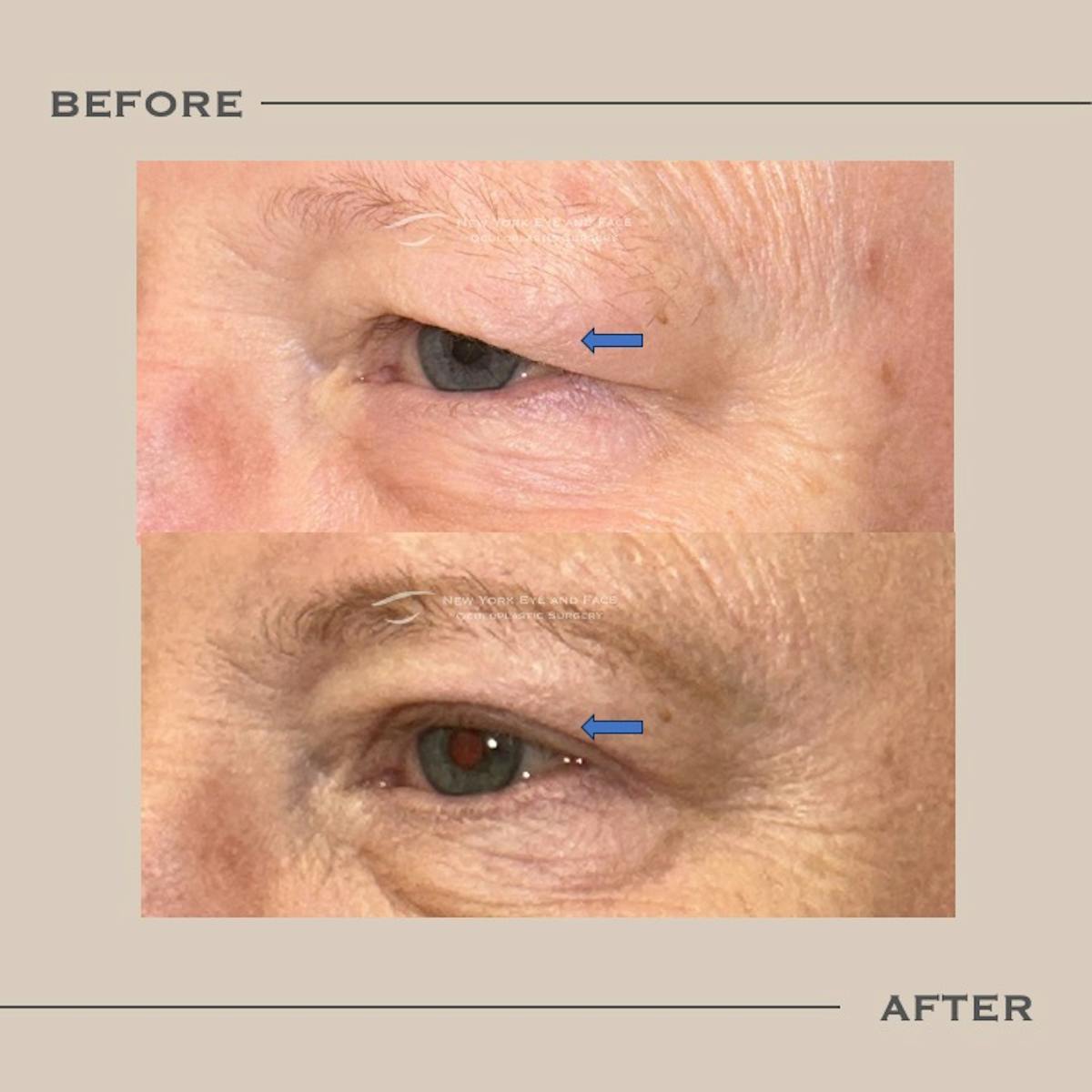 Upper Blepharoplasty Before & After Gallery - Patient 211740 - Image 3