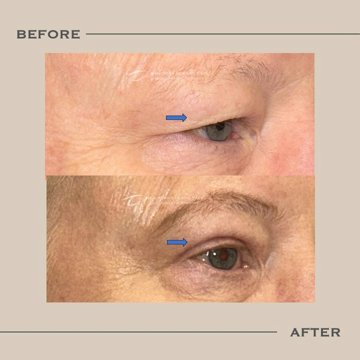 Upper Blepharoplasty Before & After Gallery - Patient 211740 - Image 2