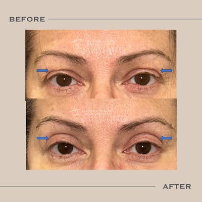 Upper Blepharoplasty Before & After Gallery - Patient 110048 - Image 1