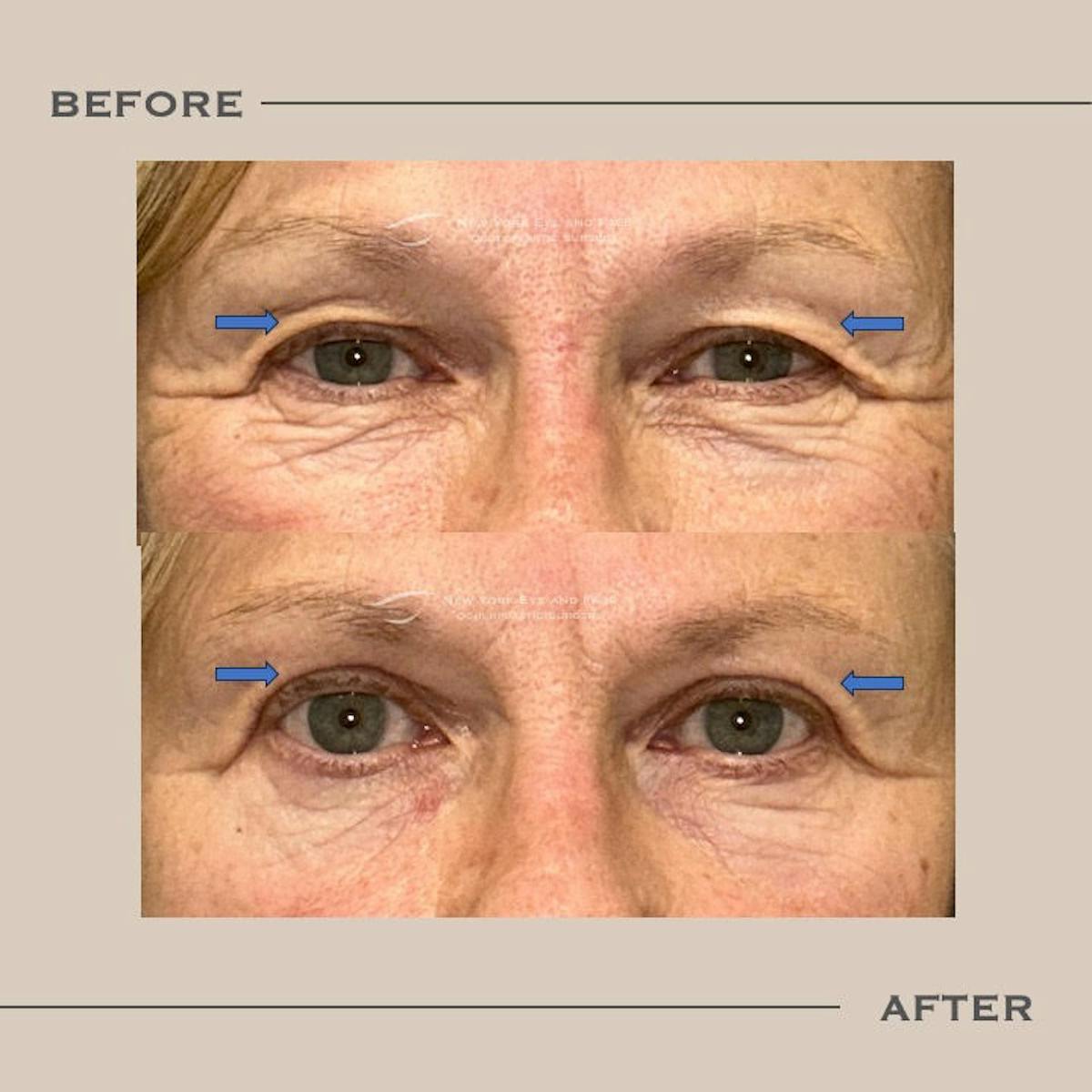 Upper Blepharoplasty Before & After Gallery - Patient 337810 - Image 1