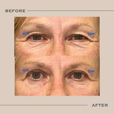 Upper Blepharoplasty Before & After Gallery - Patient 337810 - Image 1
