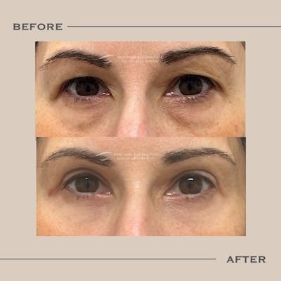 Upper Blepharoplasty Before & After Gallery - Patient 325504 - Image 1