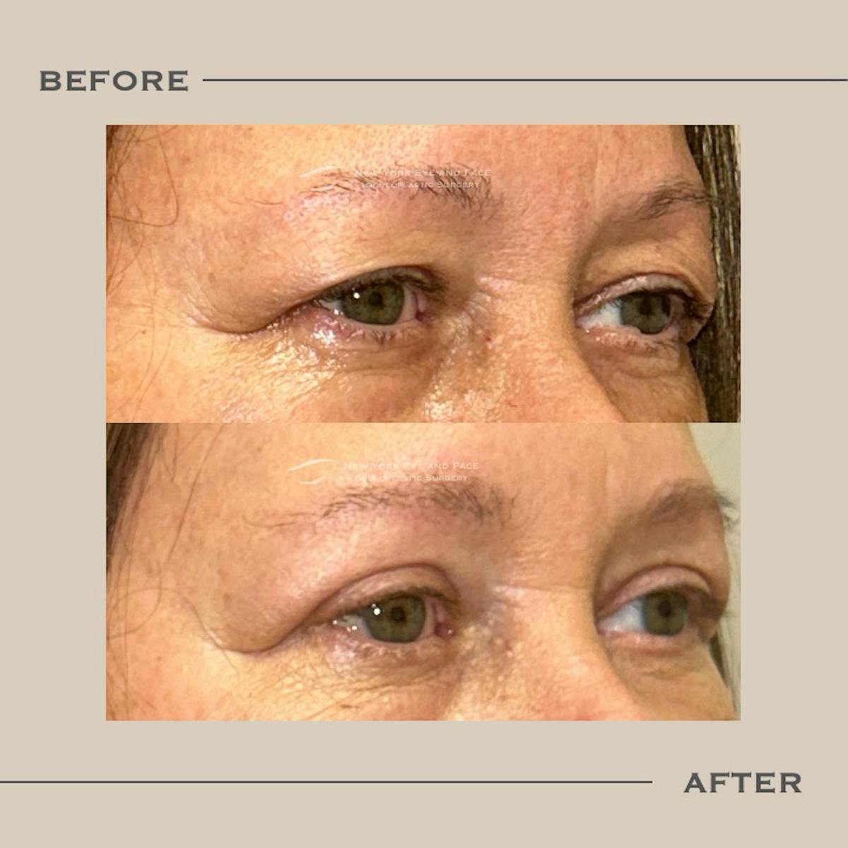 Upper Blepharoplasty Before & After Gallery - Patient 184311 - Image 2