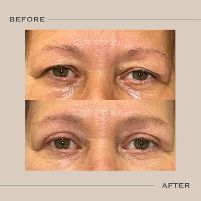 Upper Blepharoplasty Before & After Gallery - Patient 184311 - Image 1