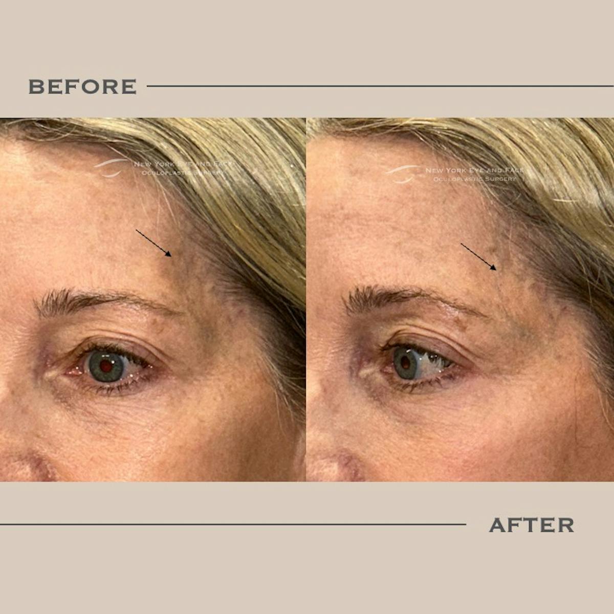 Dermal Fillers Before & After Gallery - Patient 160092 - Image 1