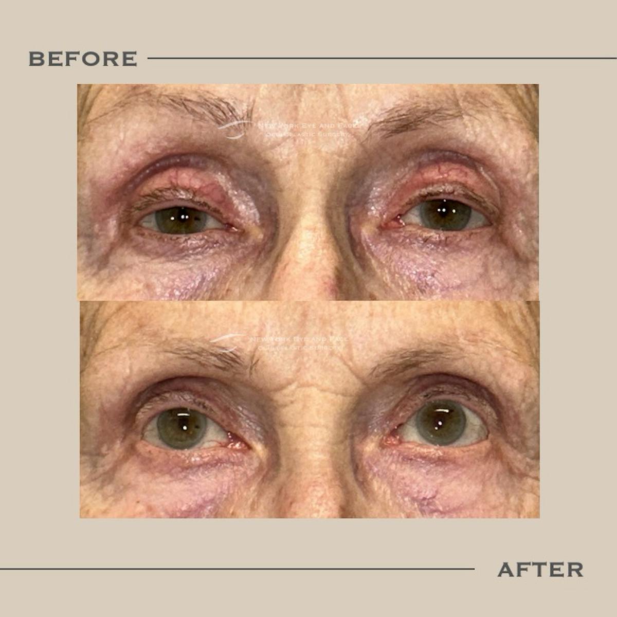 Ptosis  Before & After Gallery - Patient 970610 - Image 1
