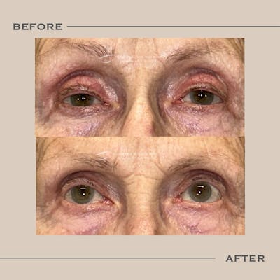 Ptosis  Before & After Gallery - Patient 970610 - Image 1