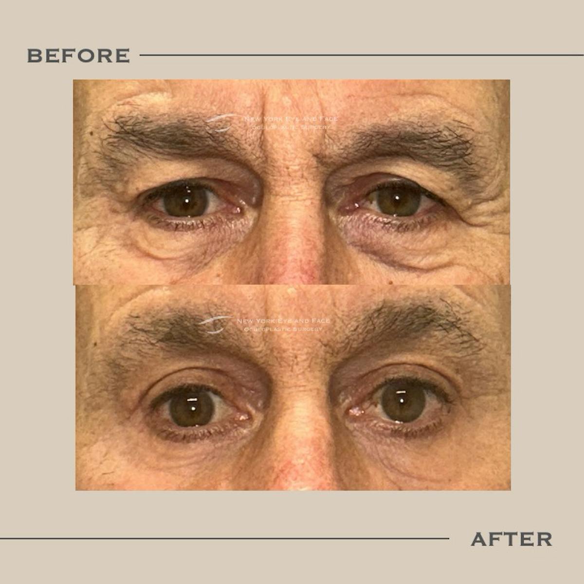 AcuPulse CO2 Laser Before & After Gallery - Patient 634720 - Image 1