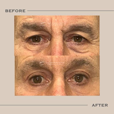 Male Blepharoplasty Before & After Gallery - Patient 144547 - Image 1