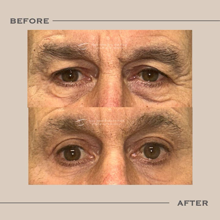 Brow Lift Before & After Gallery - Patient 221772 - Image 1