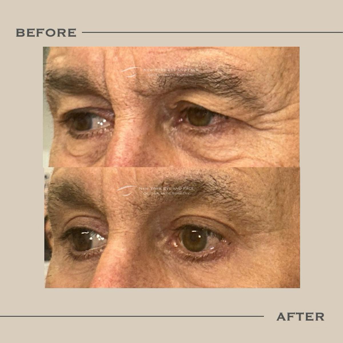 AcuPulse CO2 Laser Before & After Gallery - Patient 634720 - Image 3