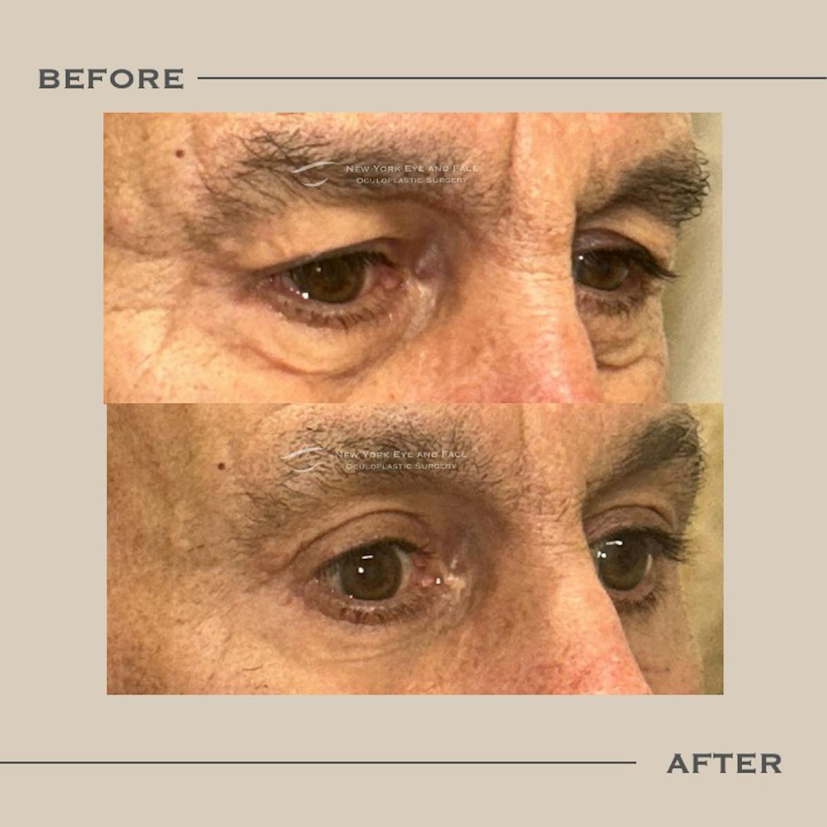 AcuPulse CO2 Laser Before & After Gallery - Patient 634720 - Image 2