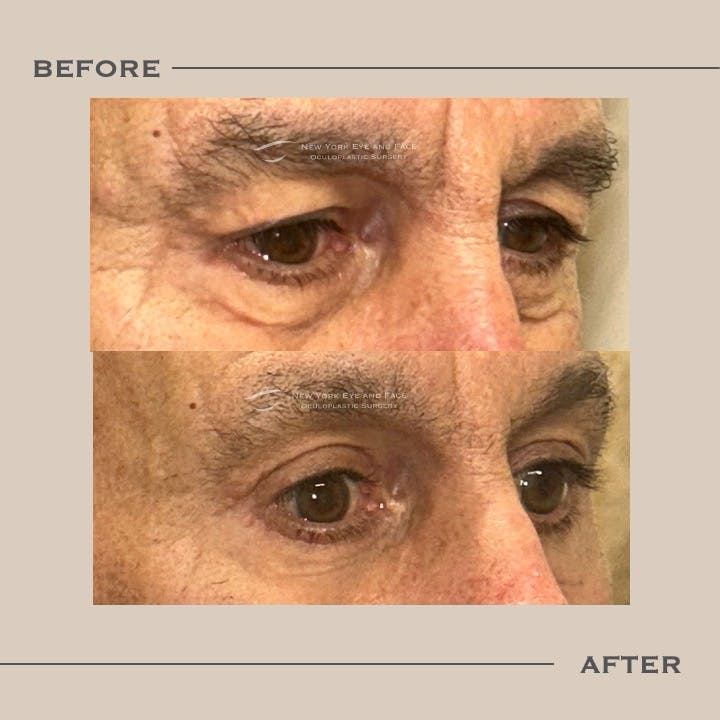 Brow Lift Before & After Gallery - Patient 221772 - Image 2