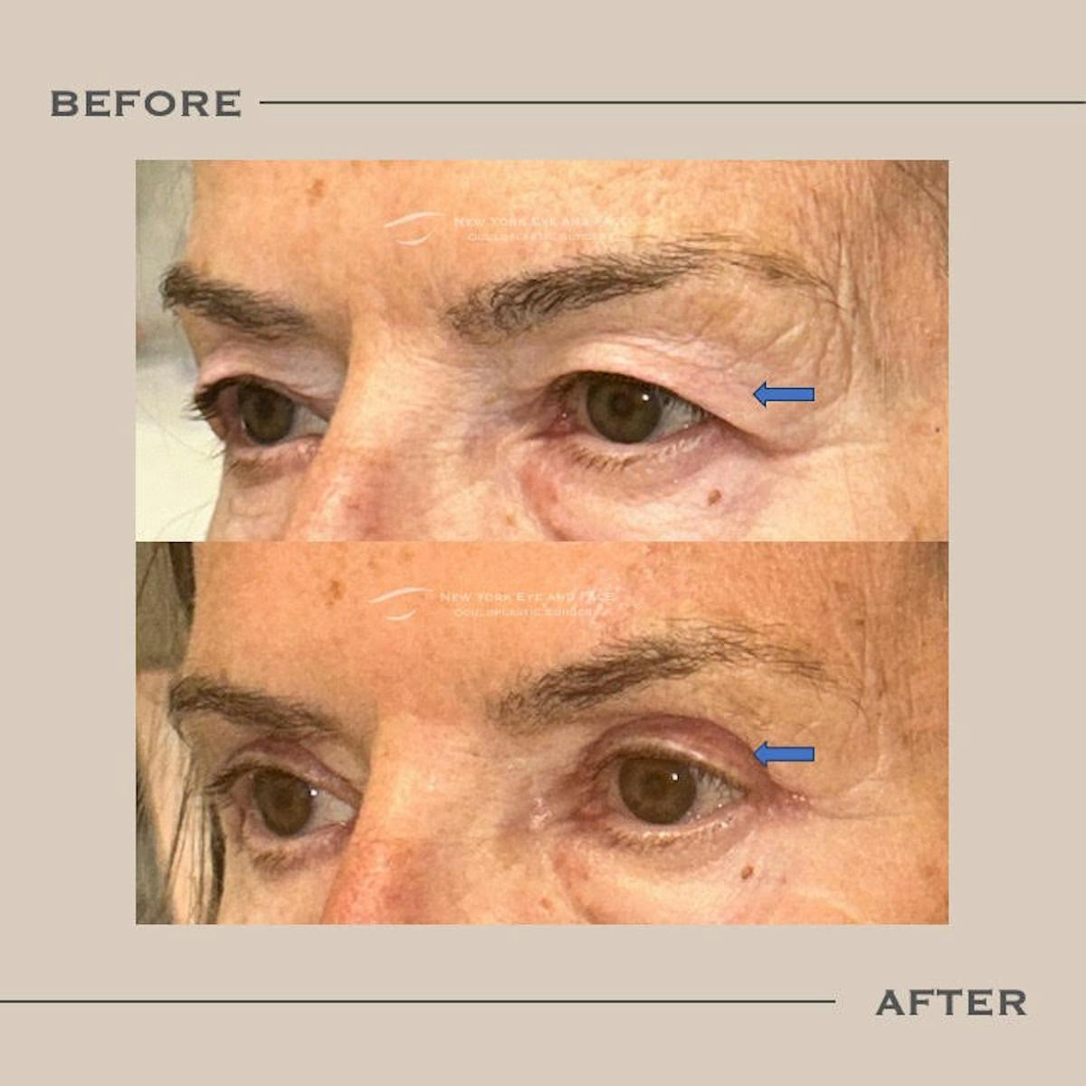 Upper Blepharoplasty Before & After Gallery - Patient 171962 - Image 3