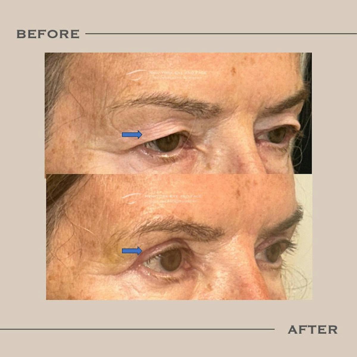 Upper Blepharoplasty Before & After Gallery - Patient 171962 - Image 2
