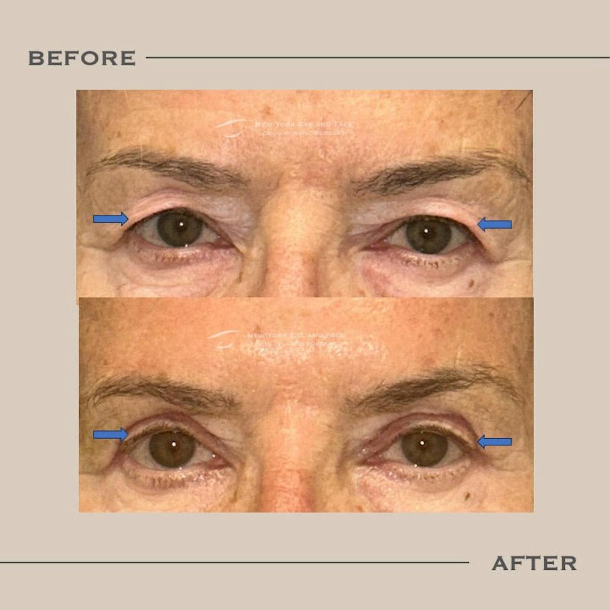 Upper Blepharoplasty Before & After Gallery - Patient 171962 - Image 1