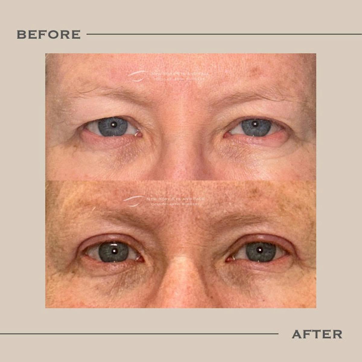 Male Blepharoplasty Before & After Gallery - Patient 240185 - Image 1