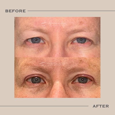 Male Blepharoplasty Before & After Gallery - Patient 240185 - Image 1