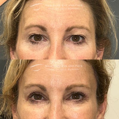 Upper Blepharoplasty Before & After Gallery - Patient 395995 - Image 1