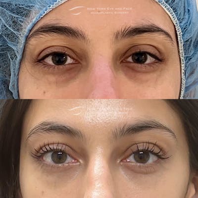 Lower Blepharoplasty Before & After Gallery - Patient 232348 - Image 1