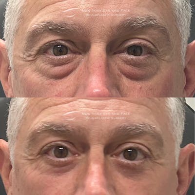 Male Blepharoplasty Before & After Gallery - Patient 311016 - Image 1
