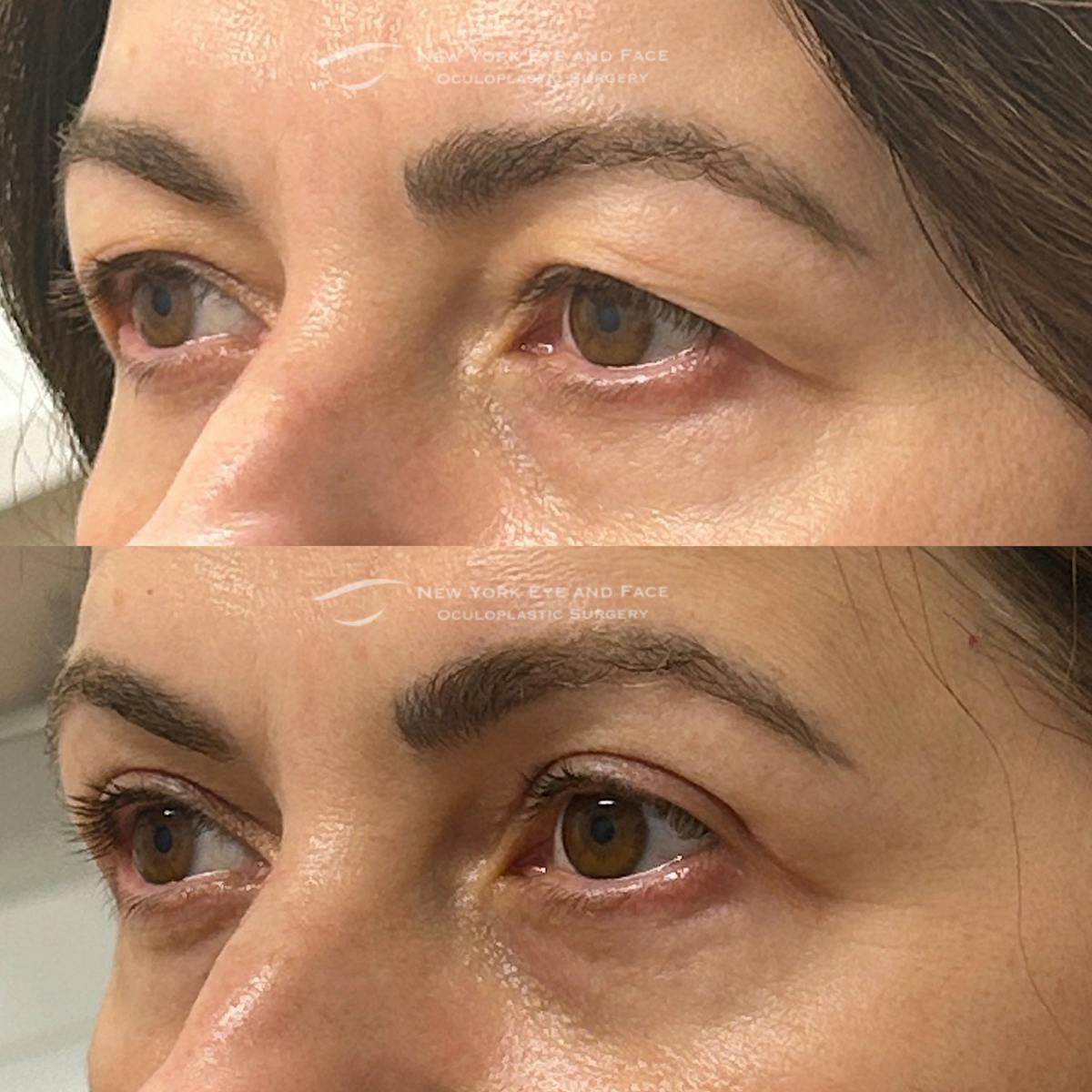 Upper Blepharoplasty Before & After Gallery - Patient 392214 - Image 3