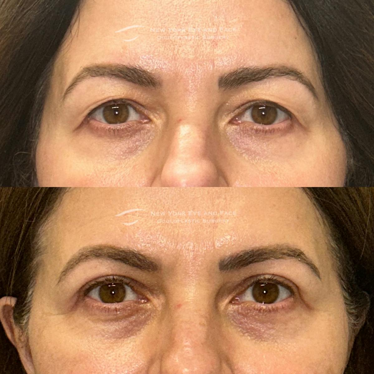 Upper Blepharoplasty Before & After Gallery - Patient 392214 - Image 1