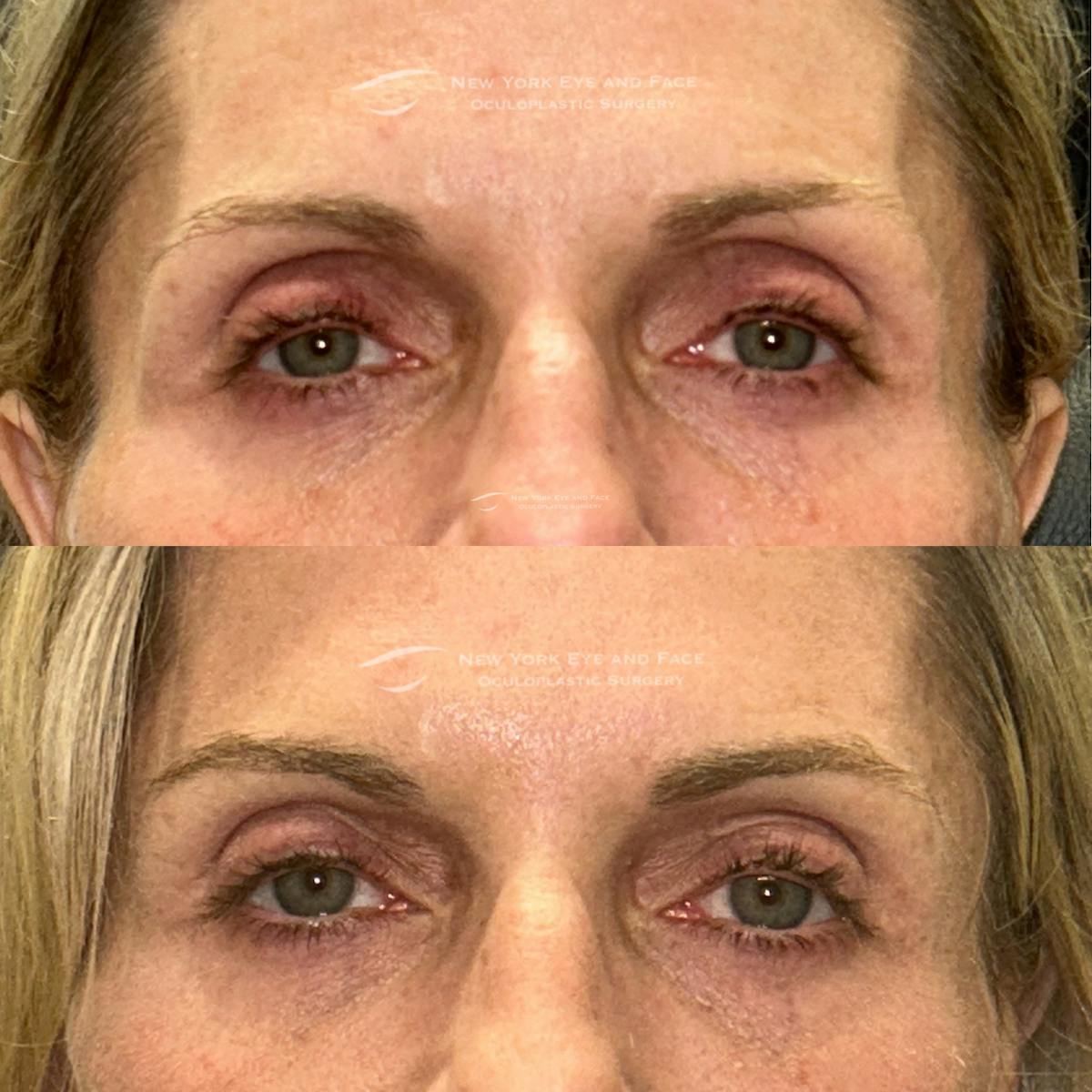 Dermal Fillers Before & After Gallery - Patient 120921 - Image 1