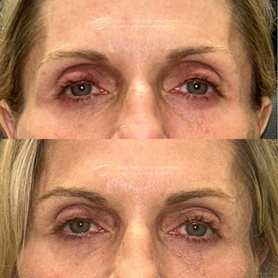 Dermal Fillers Before & After Gallery - Patient 120921 - Image 1