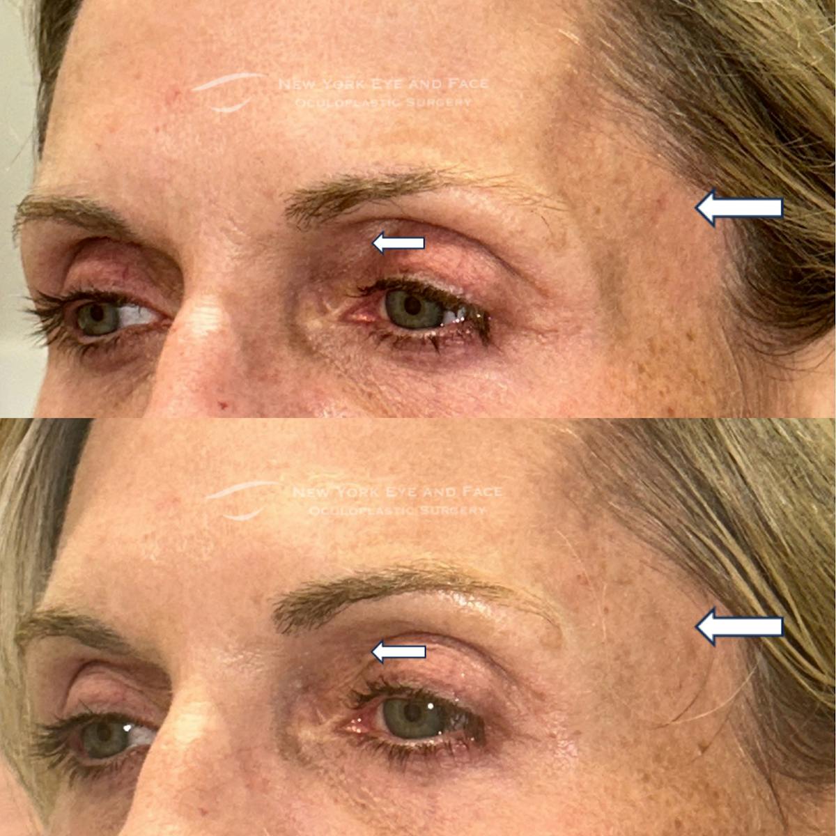 Dermal Fillers Before & After Gallery - Patient 120921 - Image 2