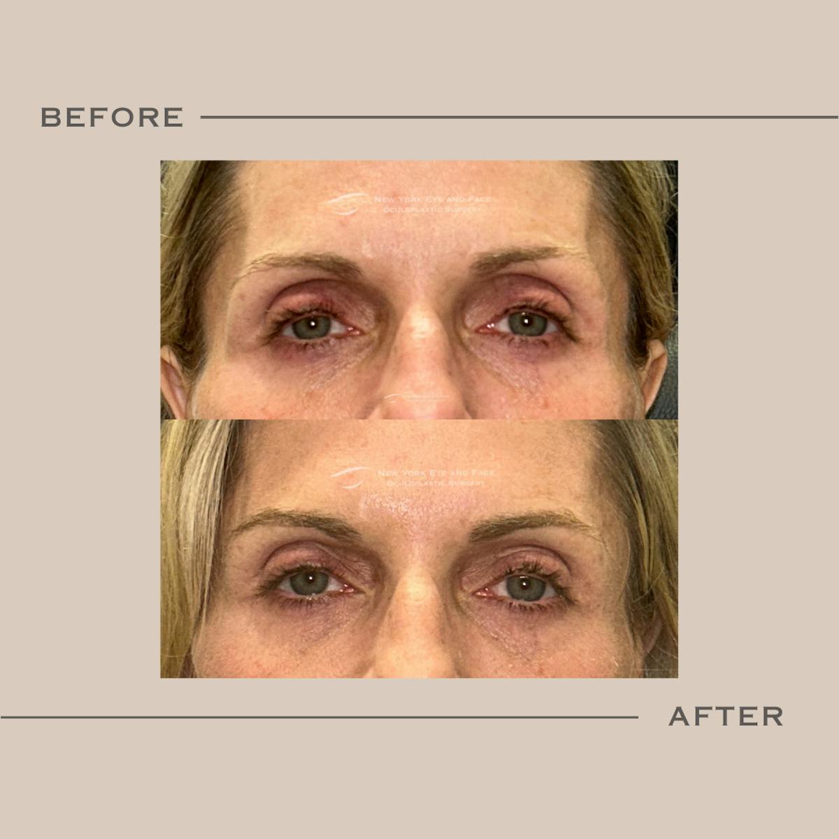 Dermal Fillers Before & After Gallery - Patient 120921 - Image 1