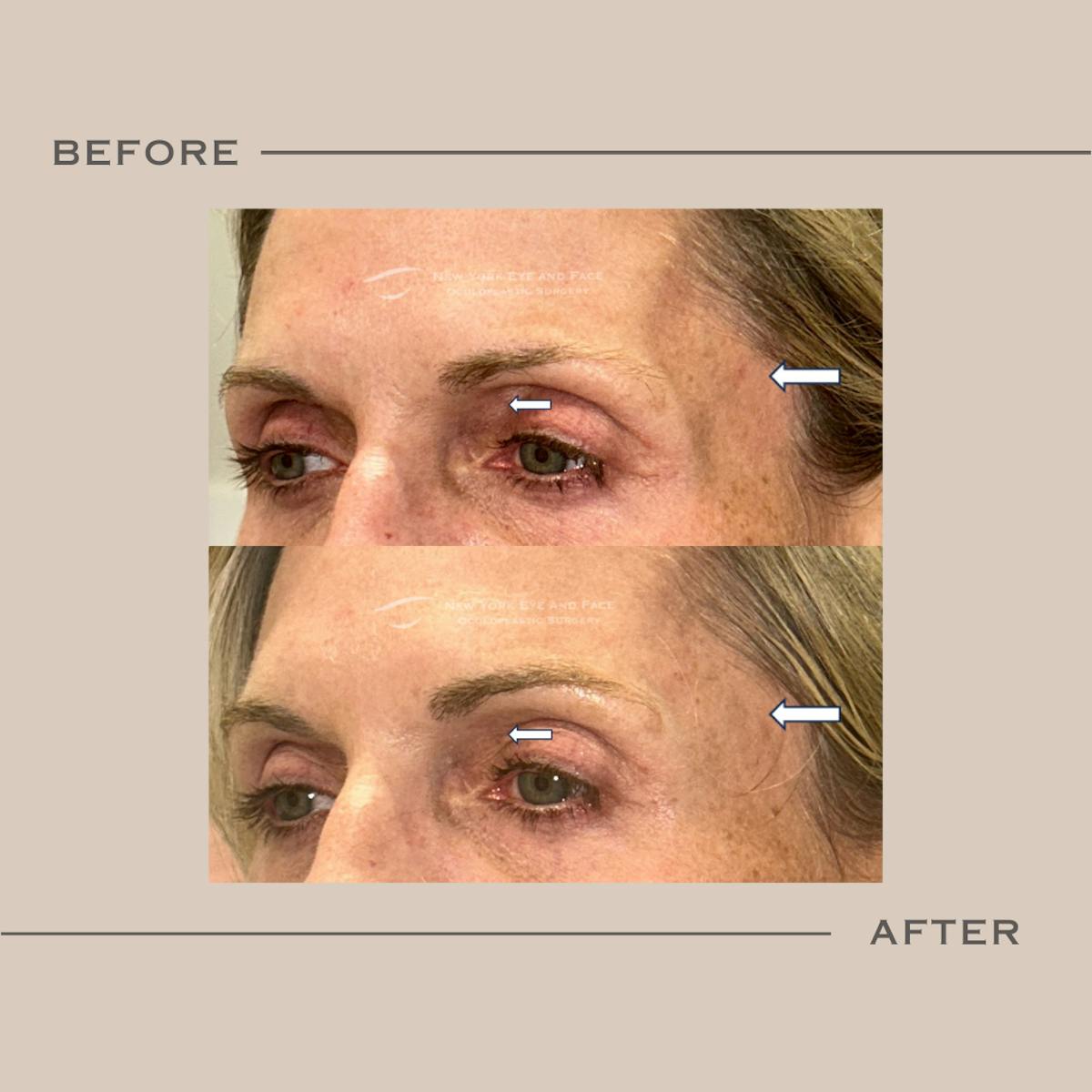 Dermal Fillers Before & After Gallery - Patient 120921 - Image 2