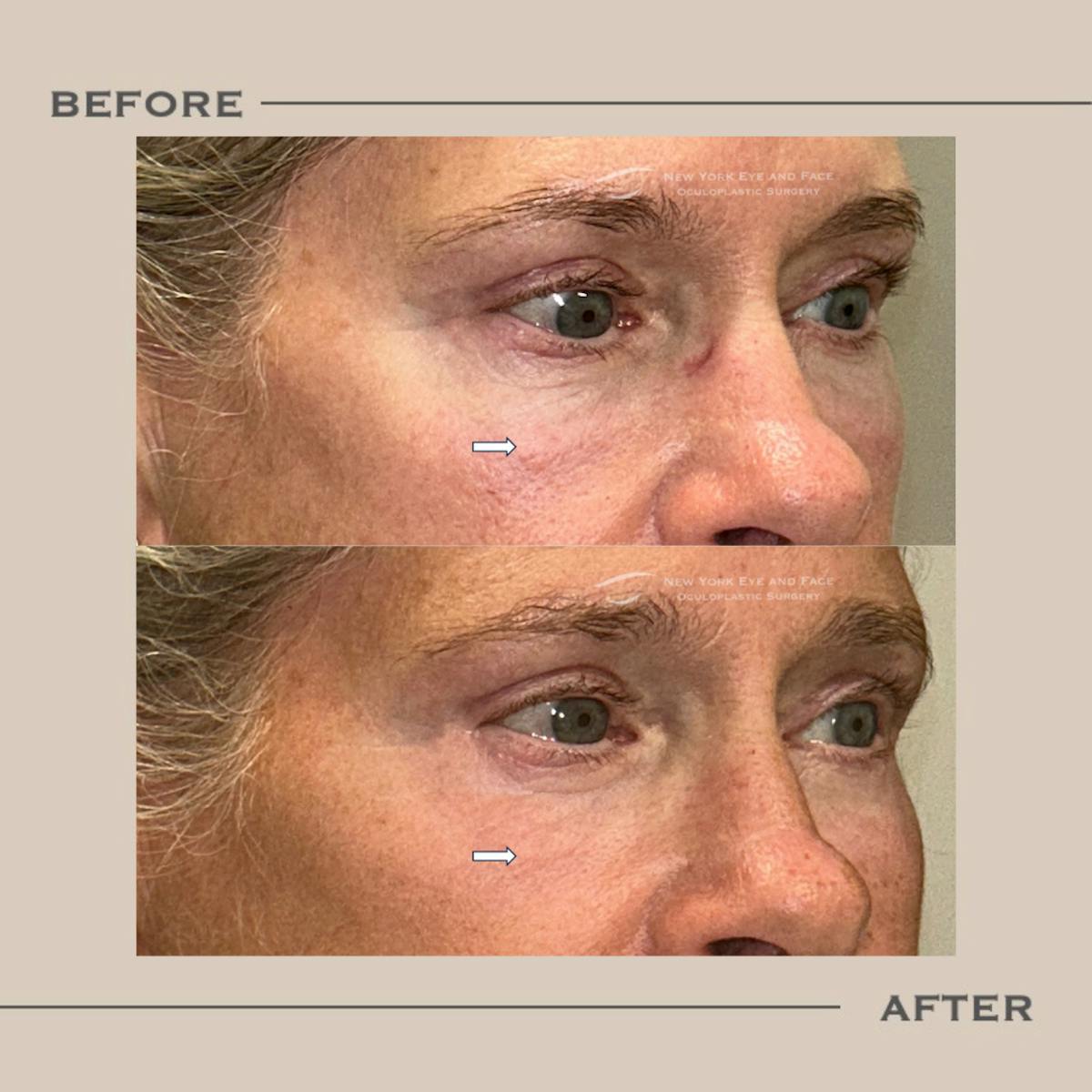 Lower Blepharoplasty Before & After Gallery - Patient 275940 - Image 2