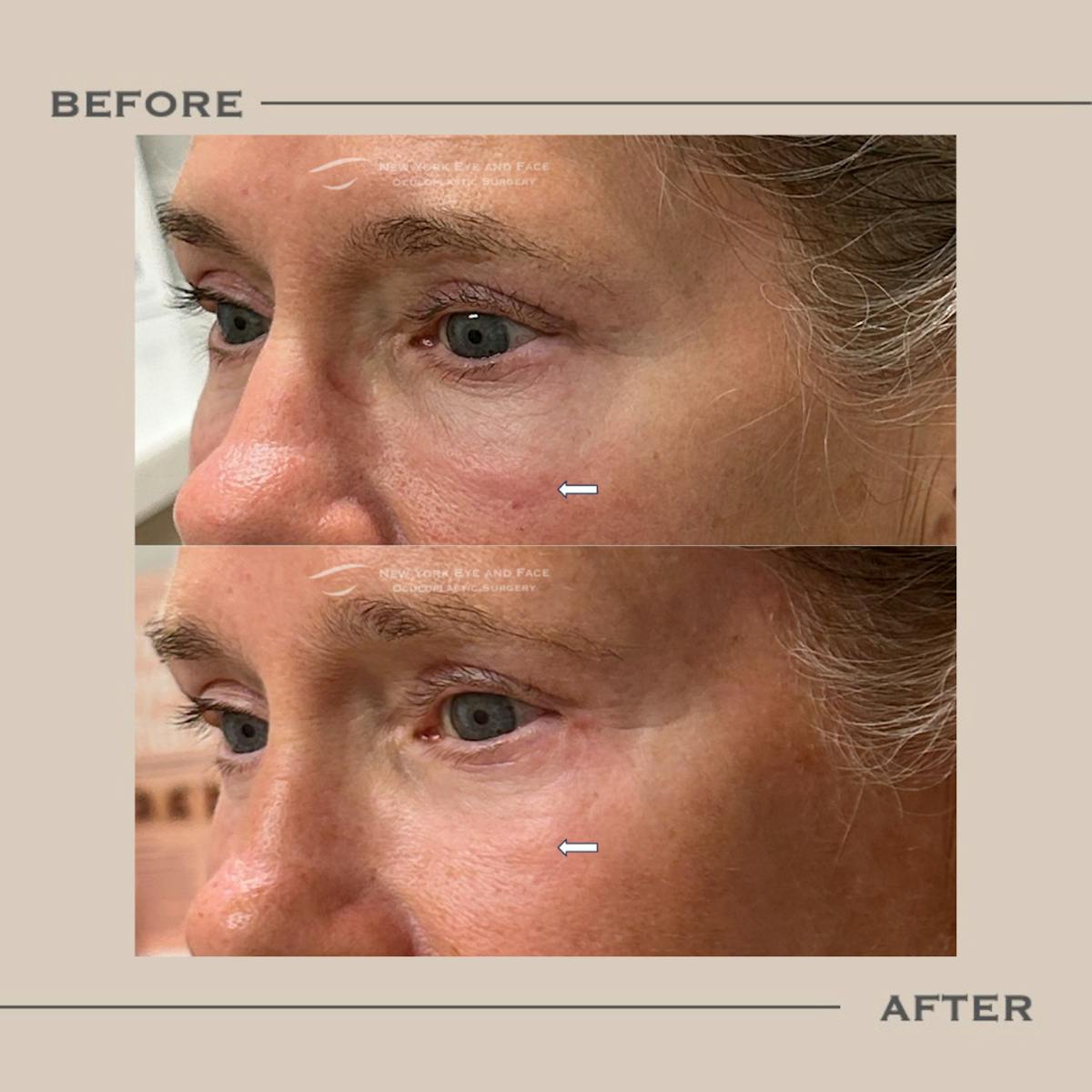 Lower Blepharoplasty Before & After Gallery - Patient 275940 - Image 1