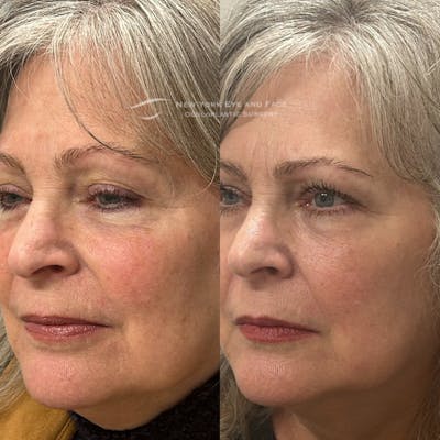 AcuPulse CO2 Laser Before & After Gallery - Patient 823421 - Image 1