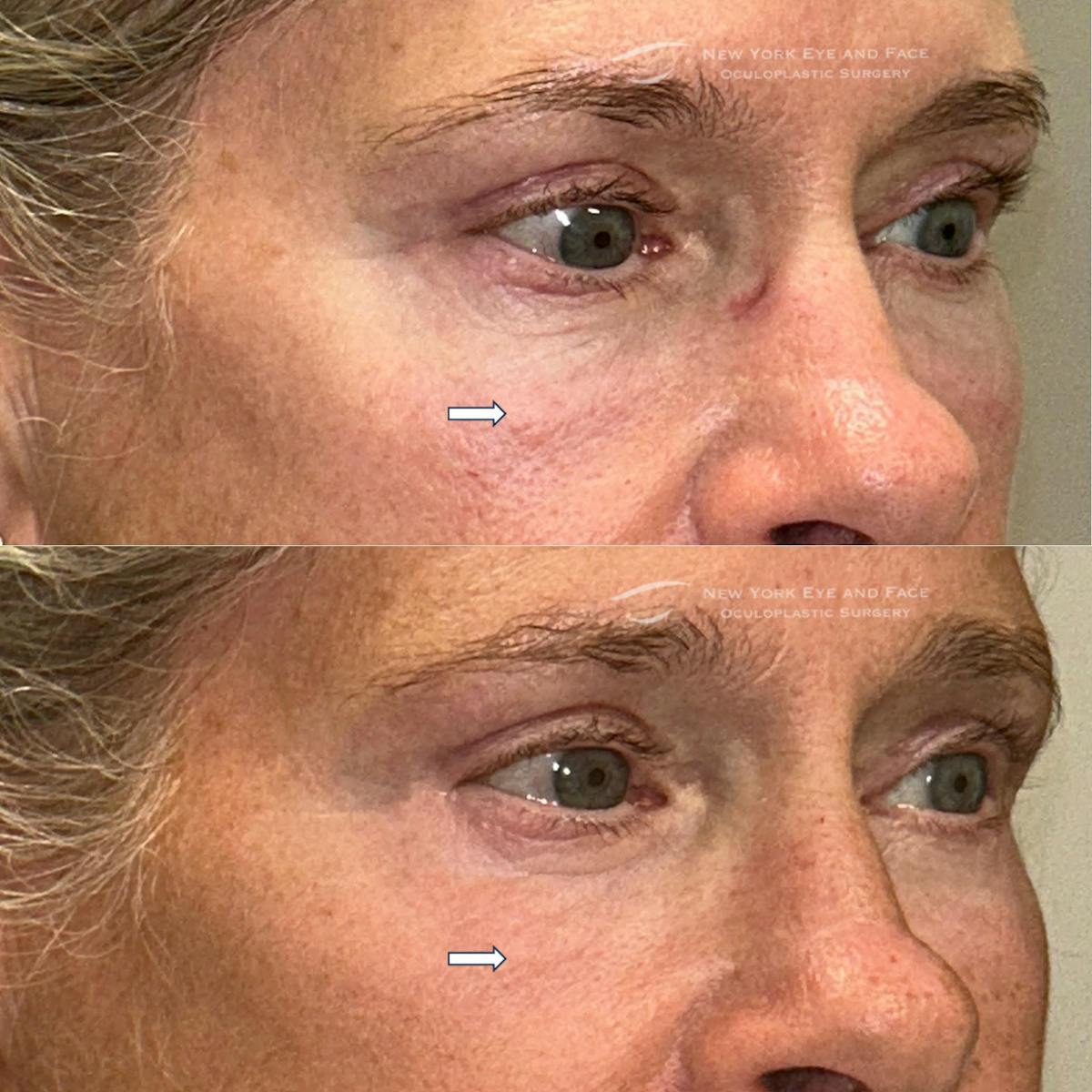 Lower Blepharoplasty Before & After Gallery - Patient 314958 - Image 1