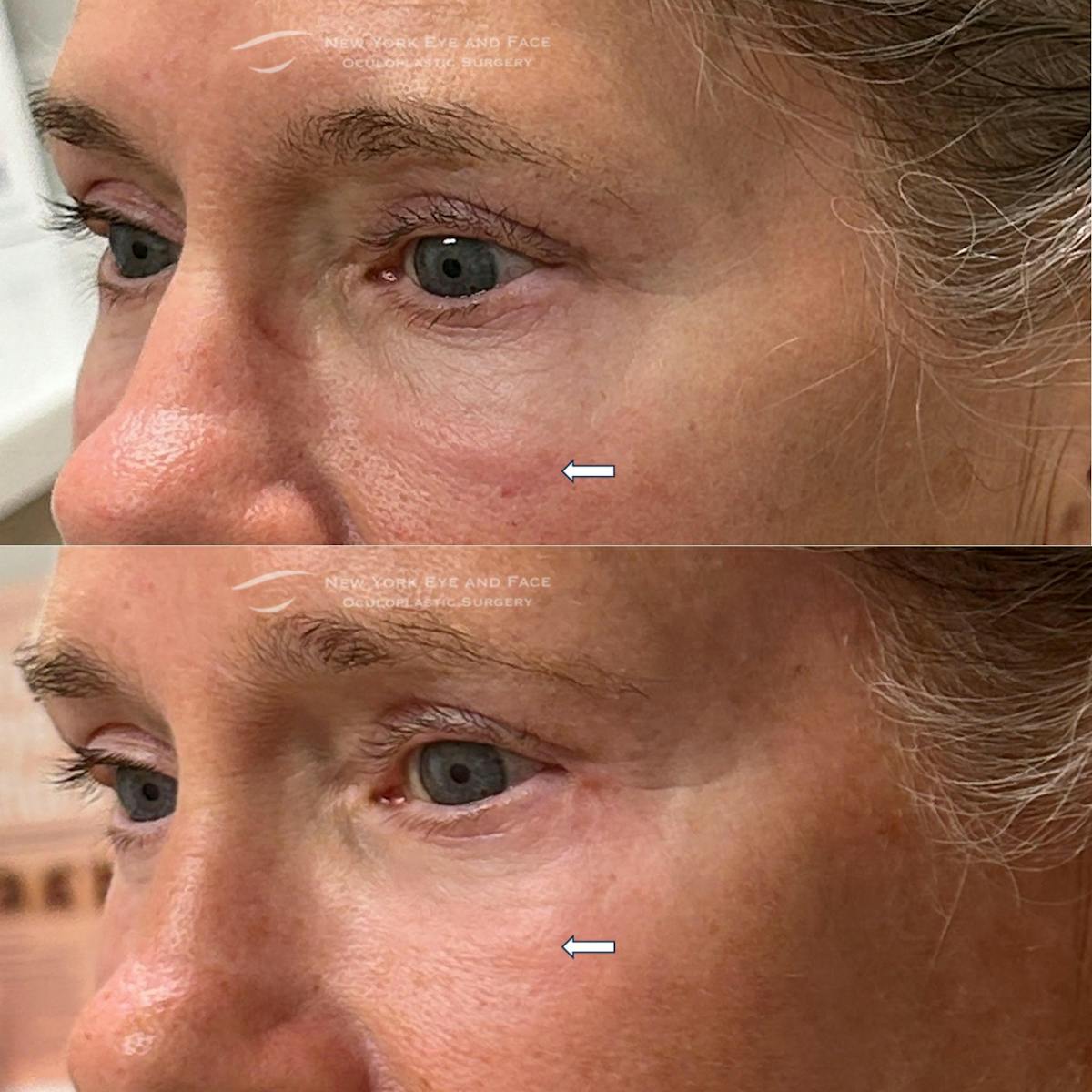 Lower Blepharoplasty Before & After Gallery - Patient 314958 - Image 2