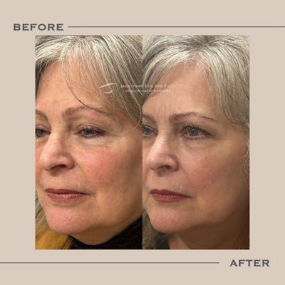 AcuPulse CO2 Laser Before & After Gallery - Patient 823421 - Image 1