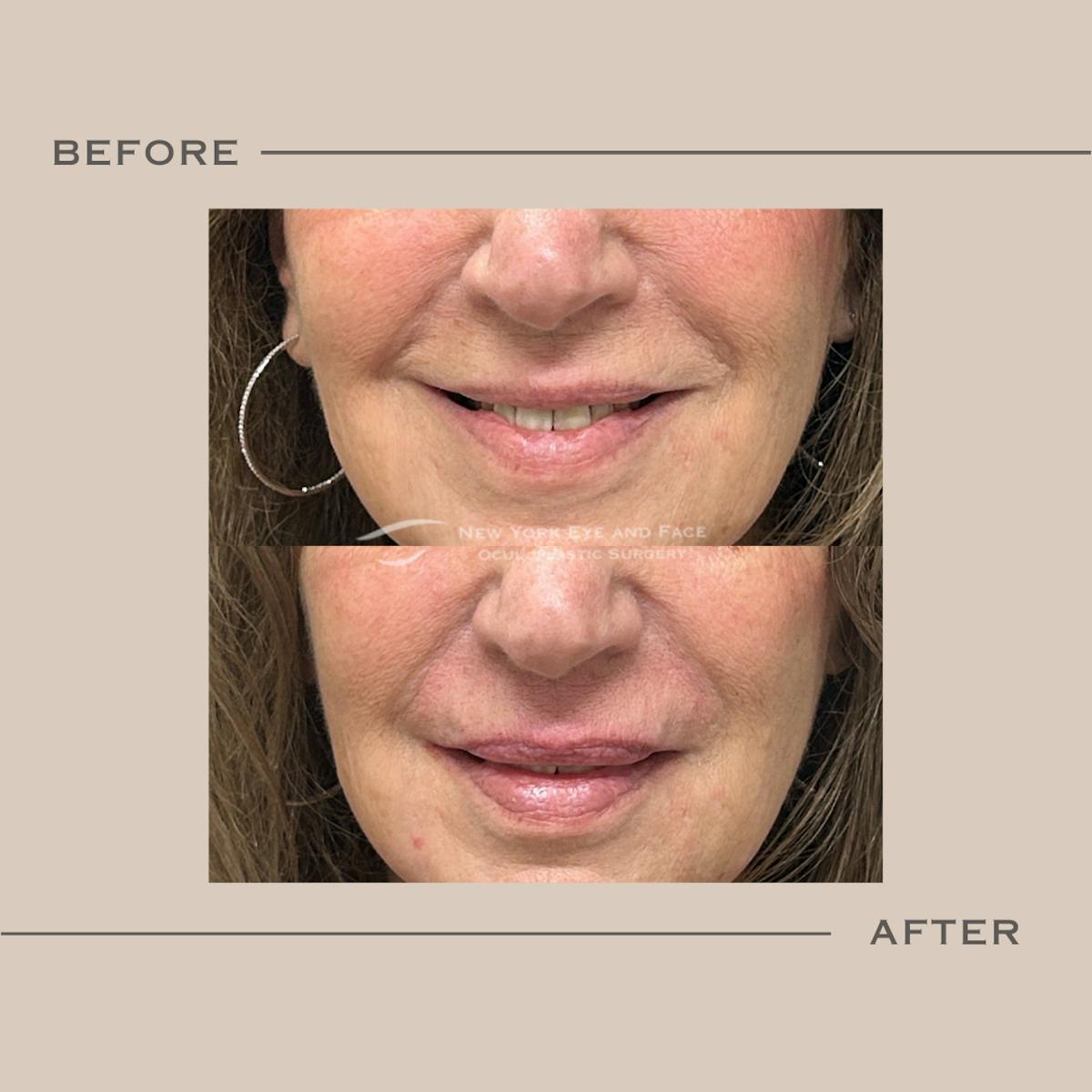 Dermal Fillers Before & After Gallery - Patient 261190 - Image 1