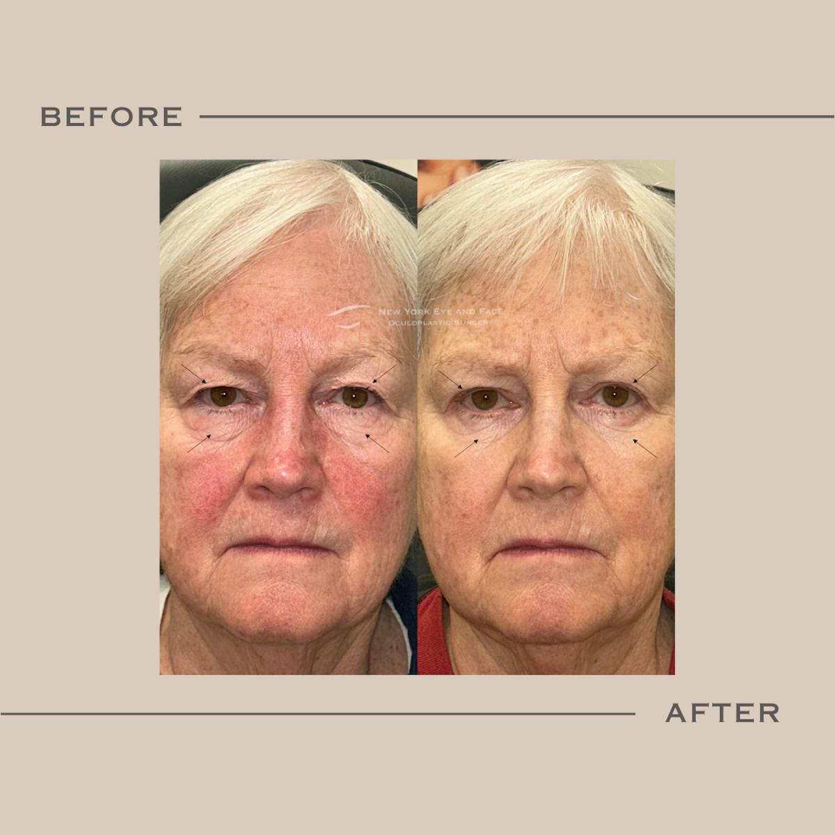 BroadBand Light (BBL) Before & After Gallery - Patient 741443 - Image 1