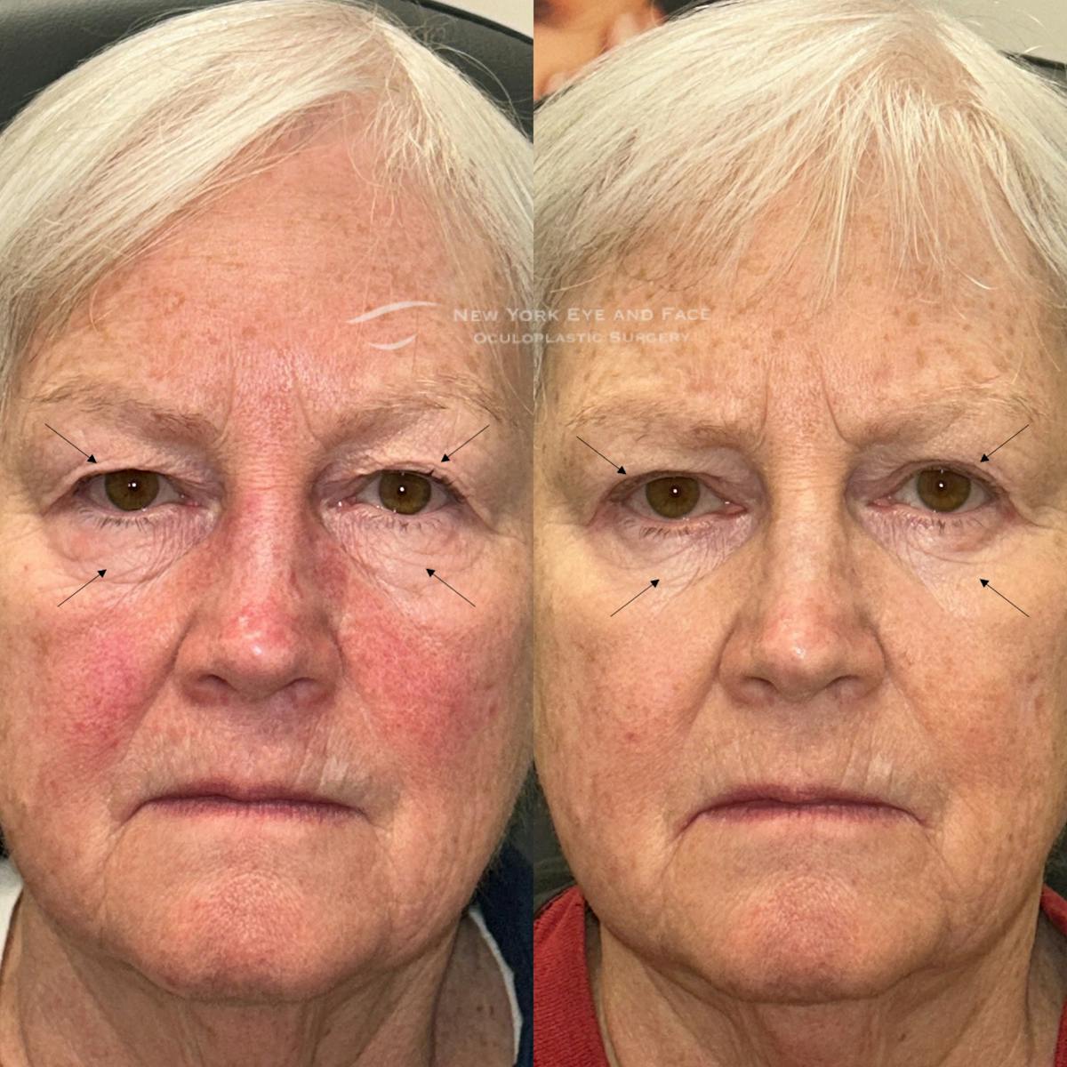 Upper Blepharoplasty Before & After Gallery - Patient 796463 - Image 1