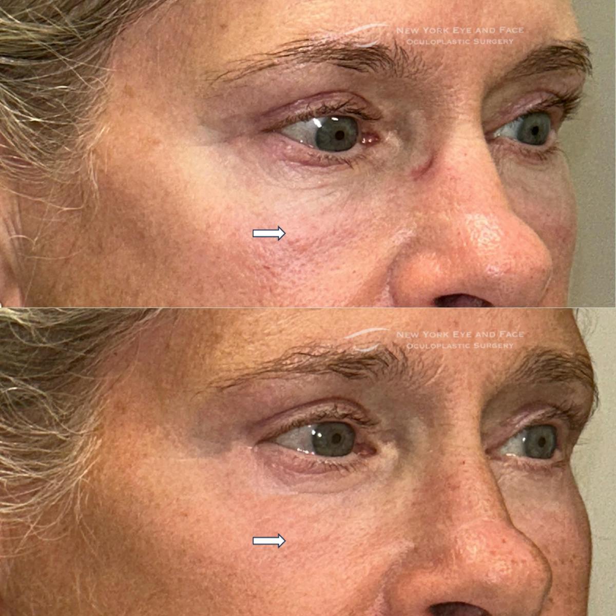 Lower Blepharoplasty Before & After Gallery - Patient 314958 - Image 2