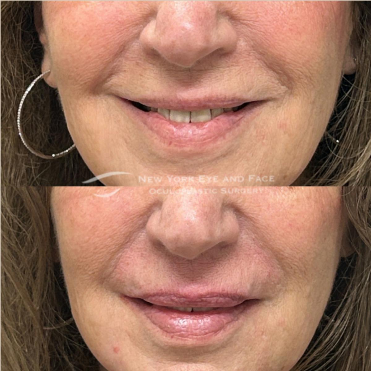 Dermal Fillers Before & After Gallery - Patient 261190 - Image 1