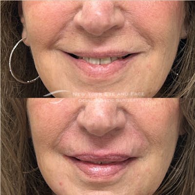 Lip Fillers Before & After Gallery - Patient 207315 - Image 1